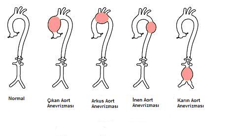 Kalp Anevrizmaları