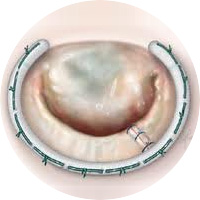 Kapak Onarımı (Plasti)