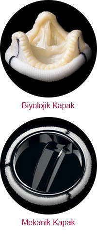 Kapak Değişimi